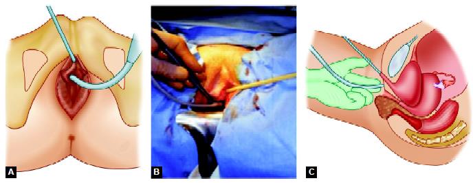 Safe entry of needle with use of urethral catheter guide