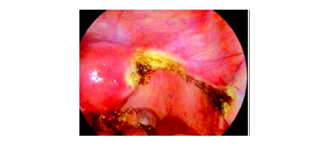 Salpingectomy