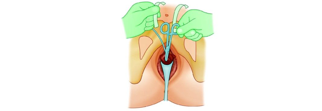 Scissors or forceps should be placed between the urethra and the tape