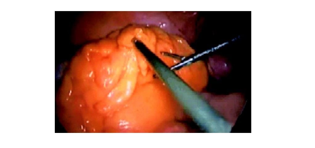 Exposure of sigmoid colon after shifting the omentum upward