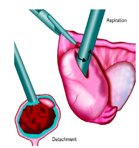 Suction of trophoblast for unruptured ectopic pregnancy