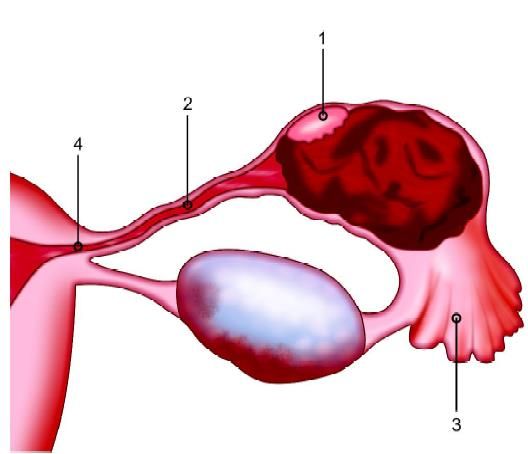 Tubal pregnancy: (1) The ampulla; (2) The isthmus (3) The infundibulum; (4) The intramural junctions