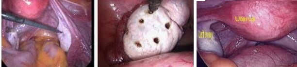 Laparoscopic Ovarian Wedge Resection and Ovarian Drilling