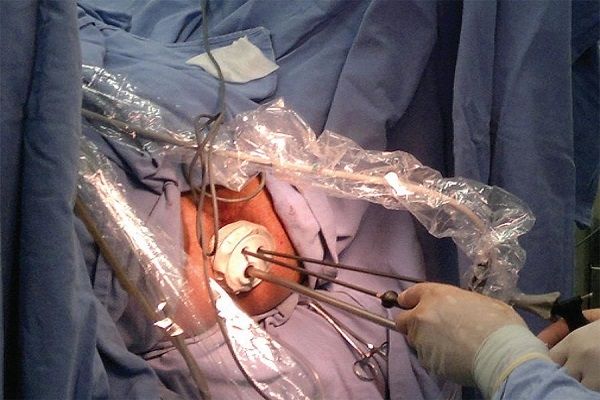 Laparoscopic total pelvic exenteration using transanal minimal invasive surgery technique