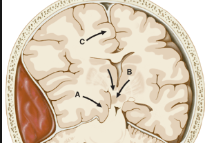 Effect of Patient Positioning on Intracranial Pressures during Laparoscopy