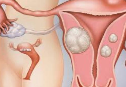Fibroid Uterus
