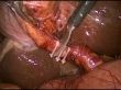Young people undergoing laparoscopic cholecystectomy is quadrupled 