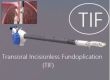 Transoral Incisionless Fundoplication (TIF) is gaining popularity
