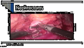 Laparoscopic Nephrectomy Performed As Day Care Surgery