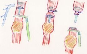 First Stapler-Enabled Pediatric Laparoscopic Duodenal Repair