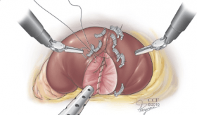 Outcomes of Laparoscopic Partial Nephrectomy in Patients Continuing Aspirin Therapy