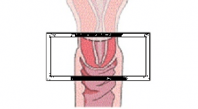 Myth about Cervical Stump after Supracervical Hysterectomy