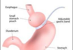Controversial lap band surgery 