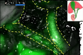 Intra-gallbladder or Systemic Indocyanide Green Injection Facilitate Cholecystectomy.
