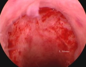 Isthmocele. Hysteroscopic & Laparoscopic surgery