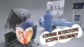 Minimally Invasive Surgical Management of a Cornual Heterotopic Ectopic Pregnancy