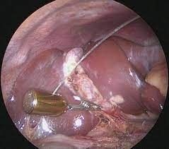 Magnetic assisted laparoscopic surgery (MALS)