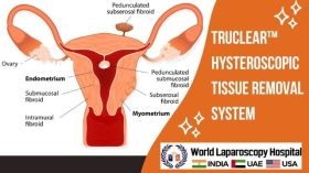TruClear™ Hysteroscopic Tissue Removal System
