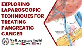 Exploring Laparoscopic Techniques for Treating Pancreatic Cancer