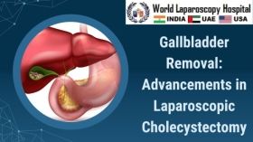 Gallbladder Removal: Advancements in Laparoscopic Cholecystectomy