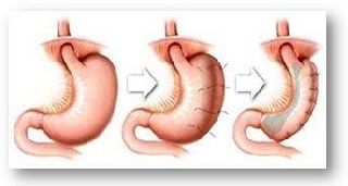 Laparoscopic Gastric Plication Operation for Patients With Severe or Morbid Obesity