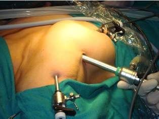 Surgeons with their own views perform fast and accurate laparoscopic procedure