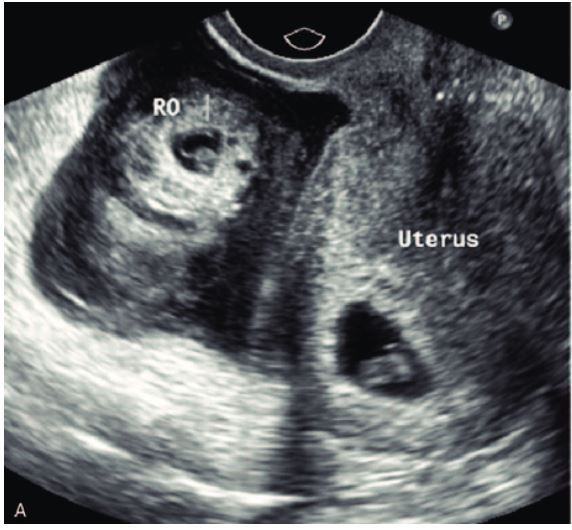 Heterotopic Pregnancy