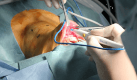 Cirugía videoendoscópica transoral (TOVES)