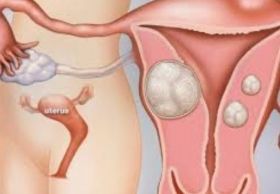 Primero en el mundo 3.5 kg de fibroma, quiste ovárico, vesícula biliar y apéndice removidos por laparoscopia