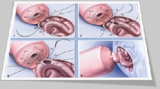 La reversión de la vasectomía asistida por robot tiene más éxito