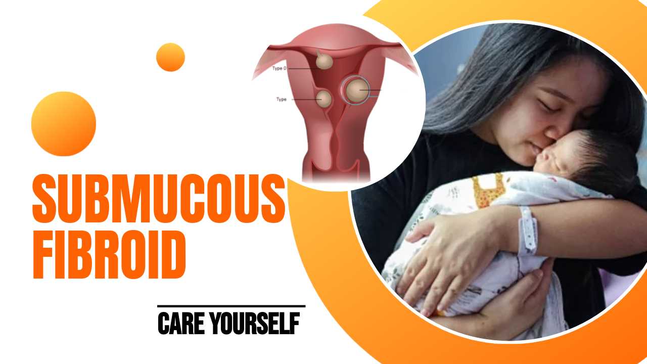 How to Care For Submucous Fibroid