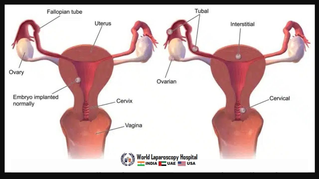 Laparoscopic myomectomy