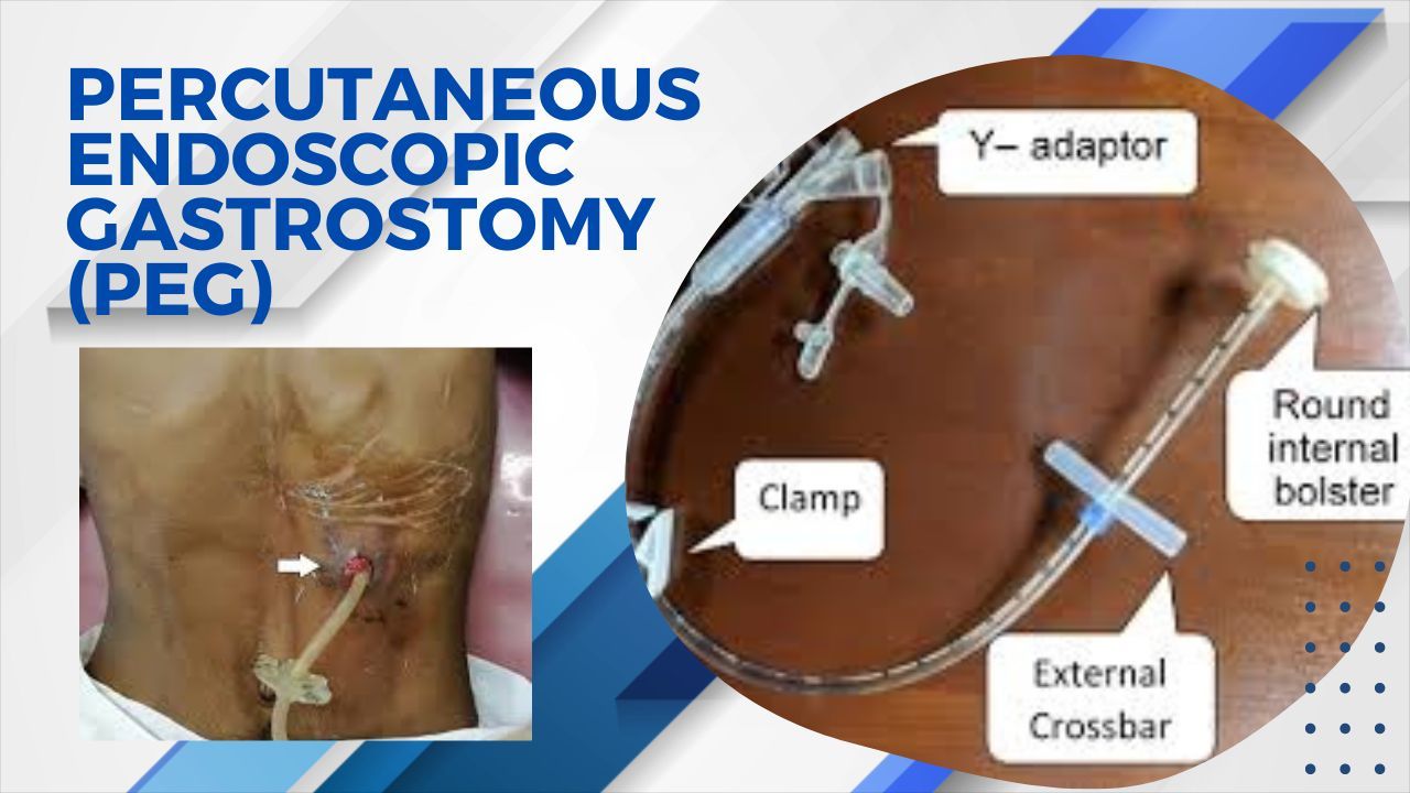 Learn everything about Percutaneous endoscopic gastrostomy (PEG)